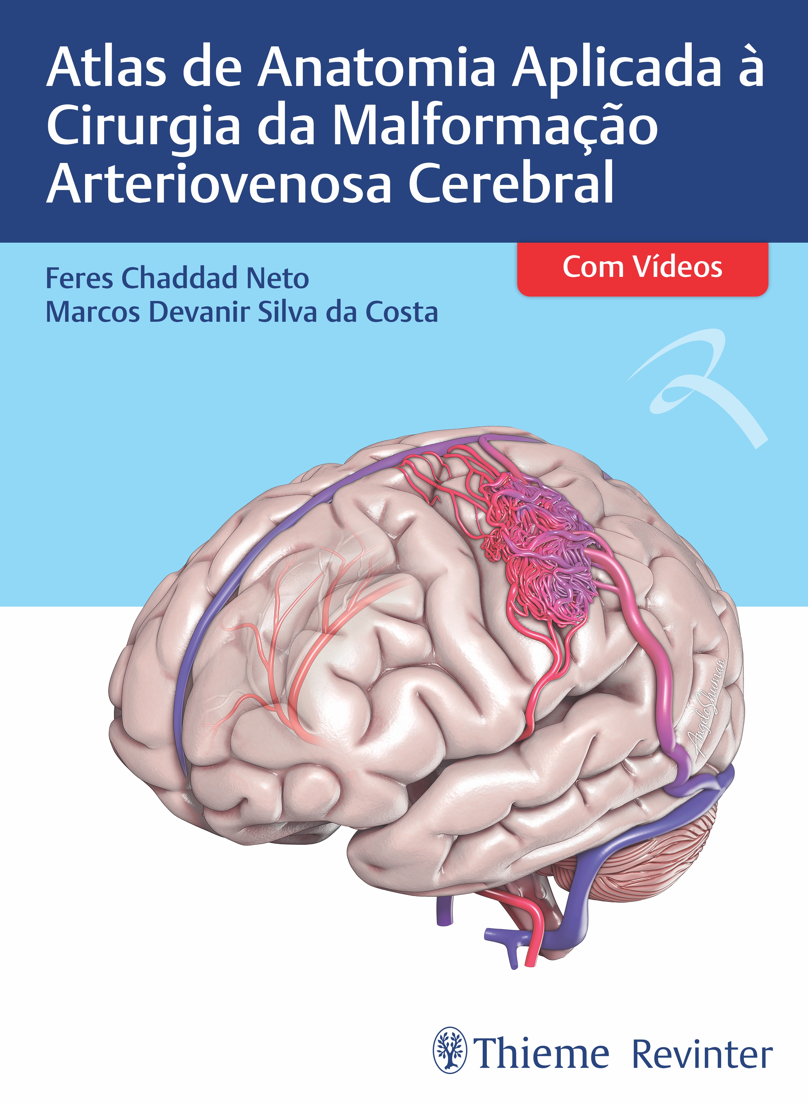 Atlas De Anatomia Aplicada À Cirurgia Da Malformação Arteriovenosa Cerebral