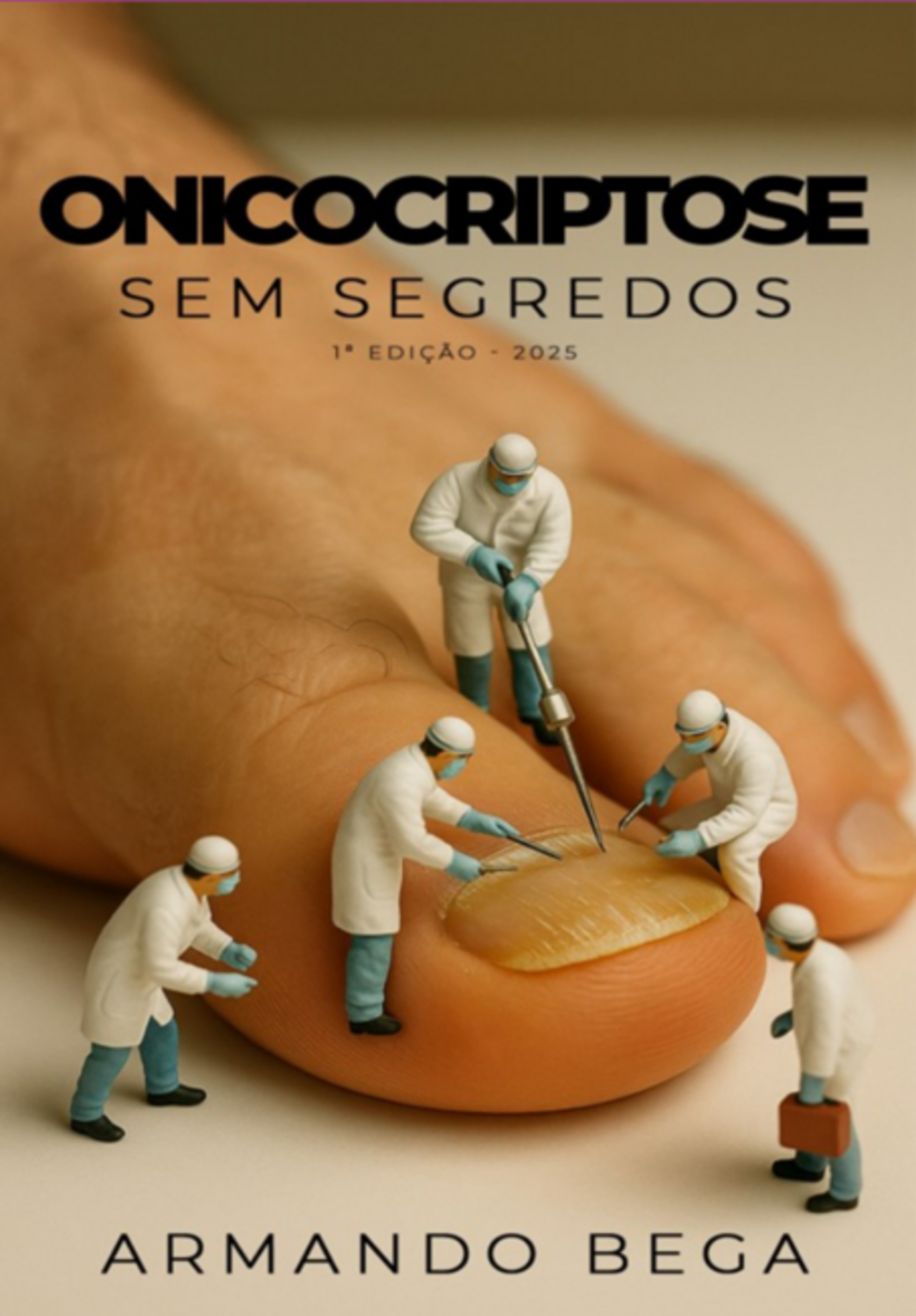 Onicocriptose Sem Segredos