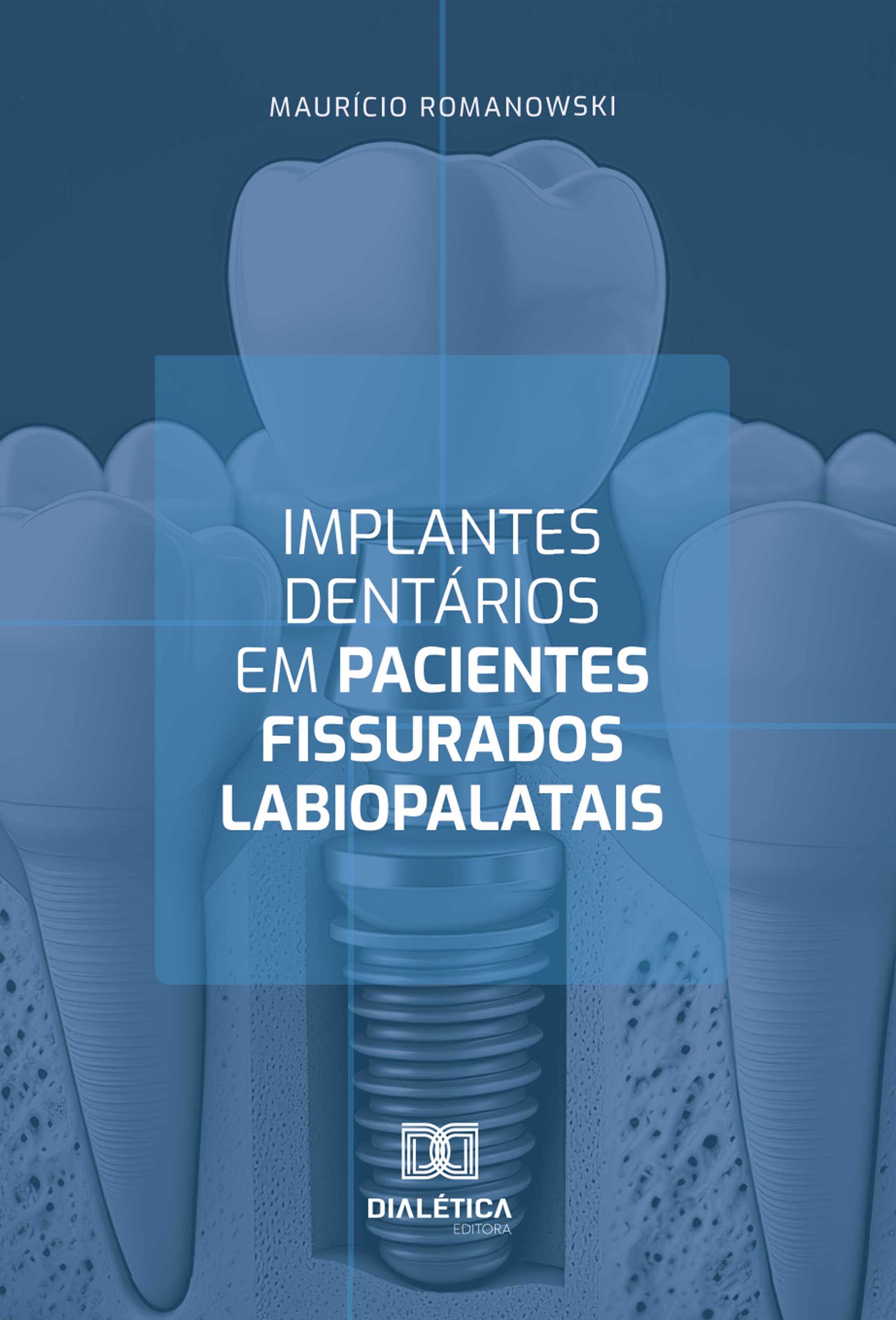 Implantes dentários em pacientes fissurados labiopalatais