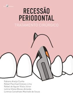 Recessão Periodontal
