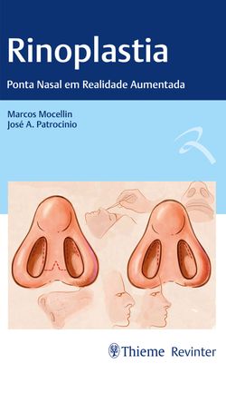 Rinoplastia