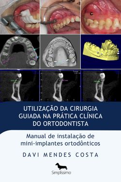 Utilização da Cirurgia Guiada na Prática Clínica do Ortodontista