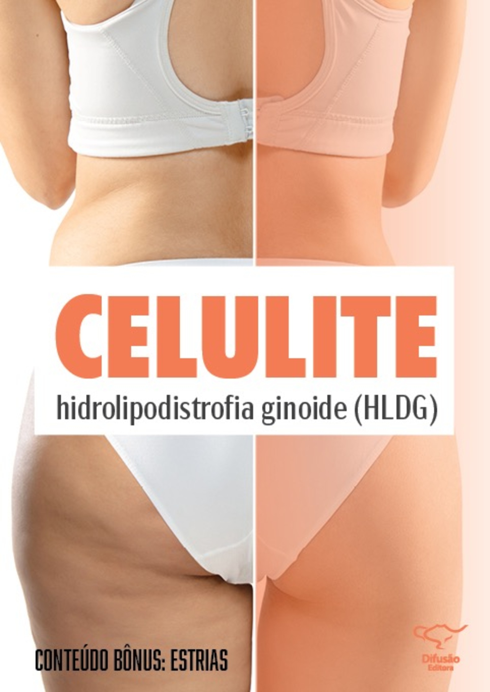 Celulite (hidrolipodistrofia ginoide - HLDG) e Estrias