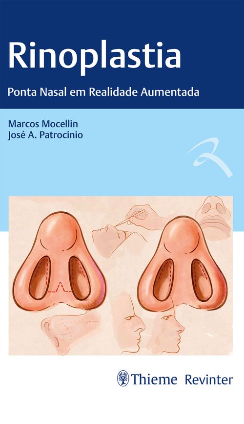 Rinoplastia